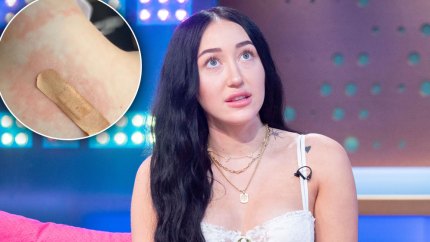 noah cyrus spider bite